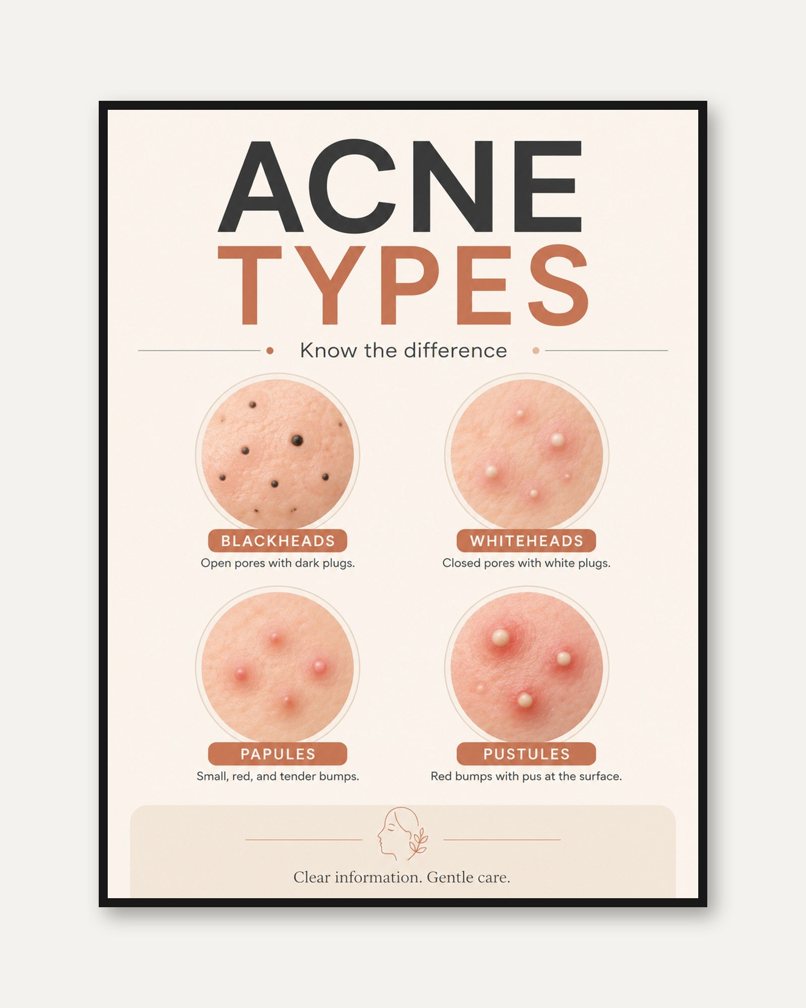 Skincare Poster – Acne Types Educational Print - framed