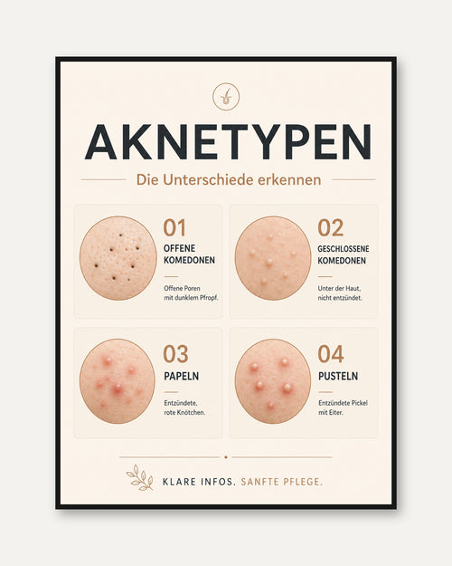 Acne Types Poster – Dermatology Wall Art - framed